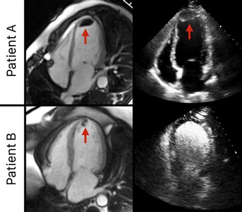 lv thrombi|left ventricular thrombus heart attack.